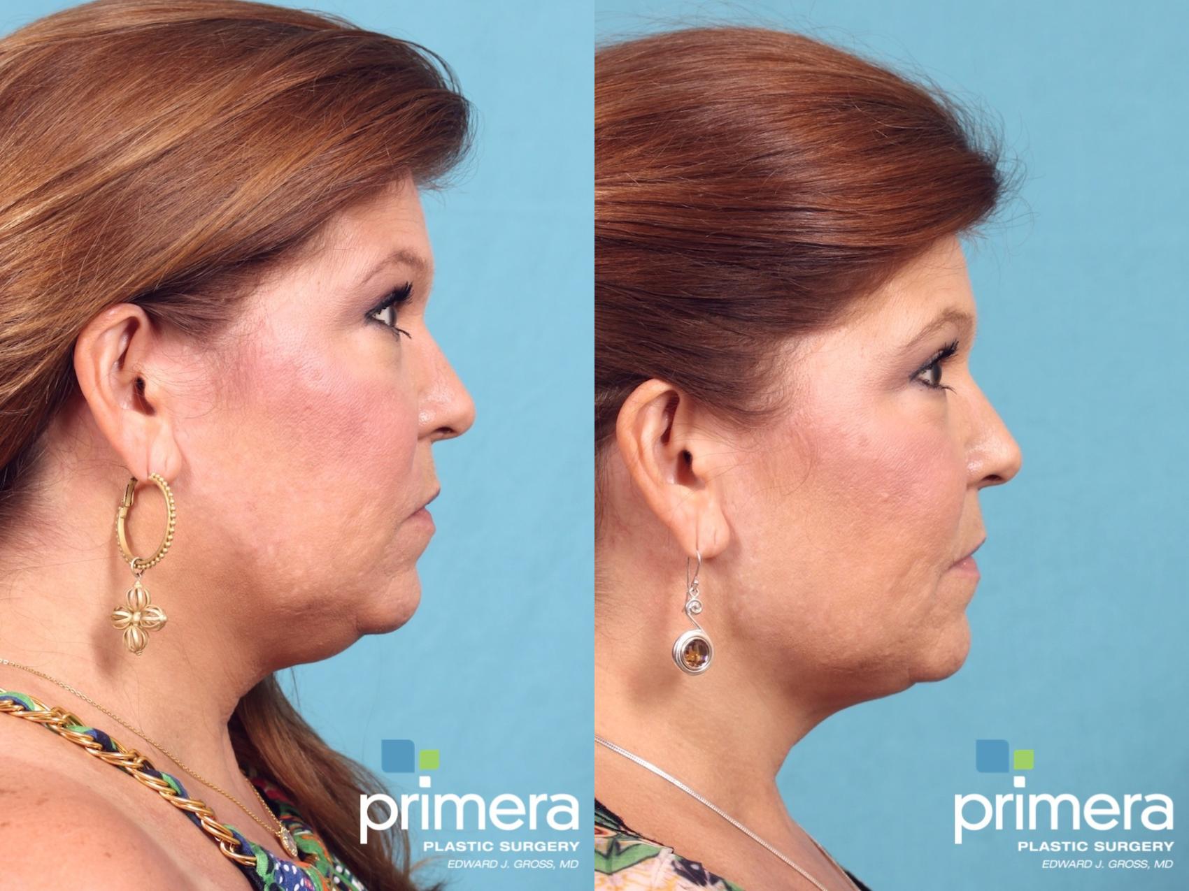 Ultherapy® Skin Tightening for Orlando & Winter Park, FL