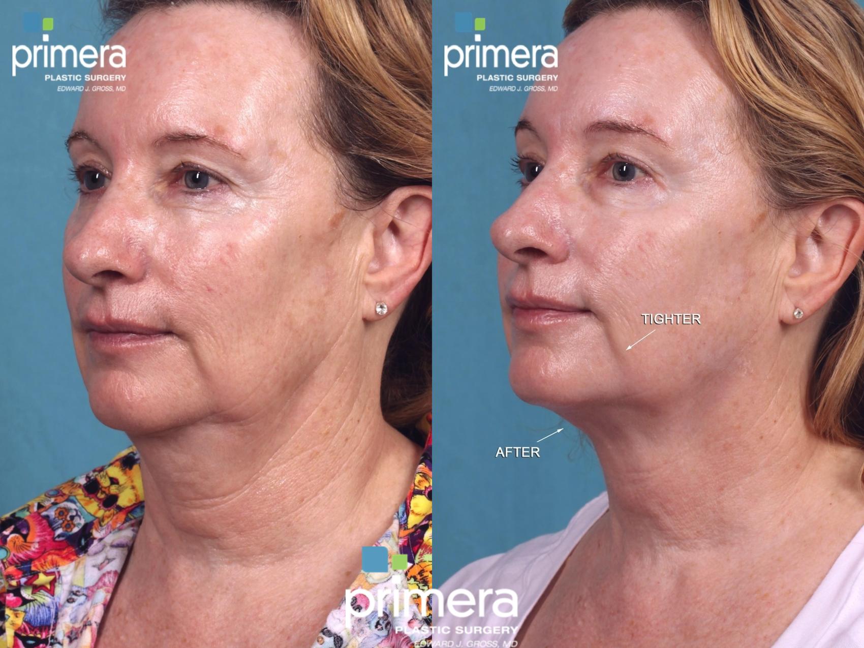 Ulthera Facial Skin Tightening West Island, Montreal - Plastic Surgery