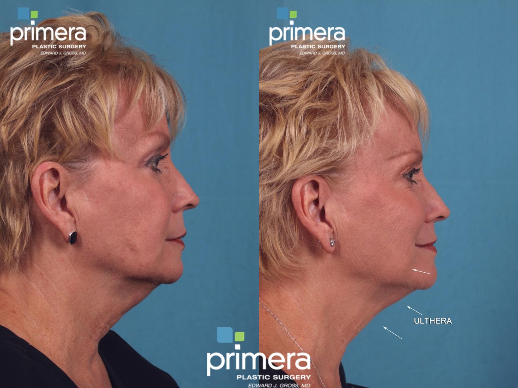 Ultherapy® Before And After Pictures Case 387 Orlando Florida