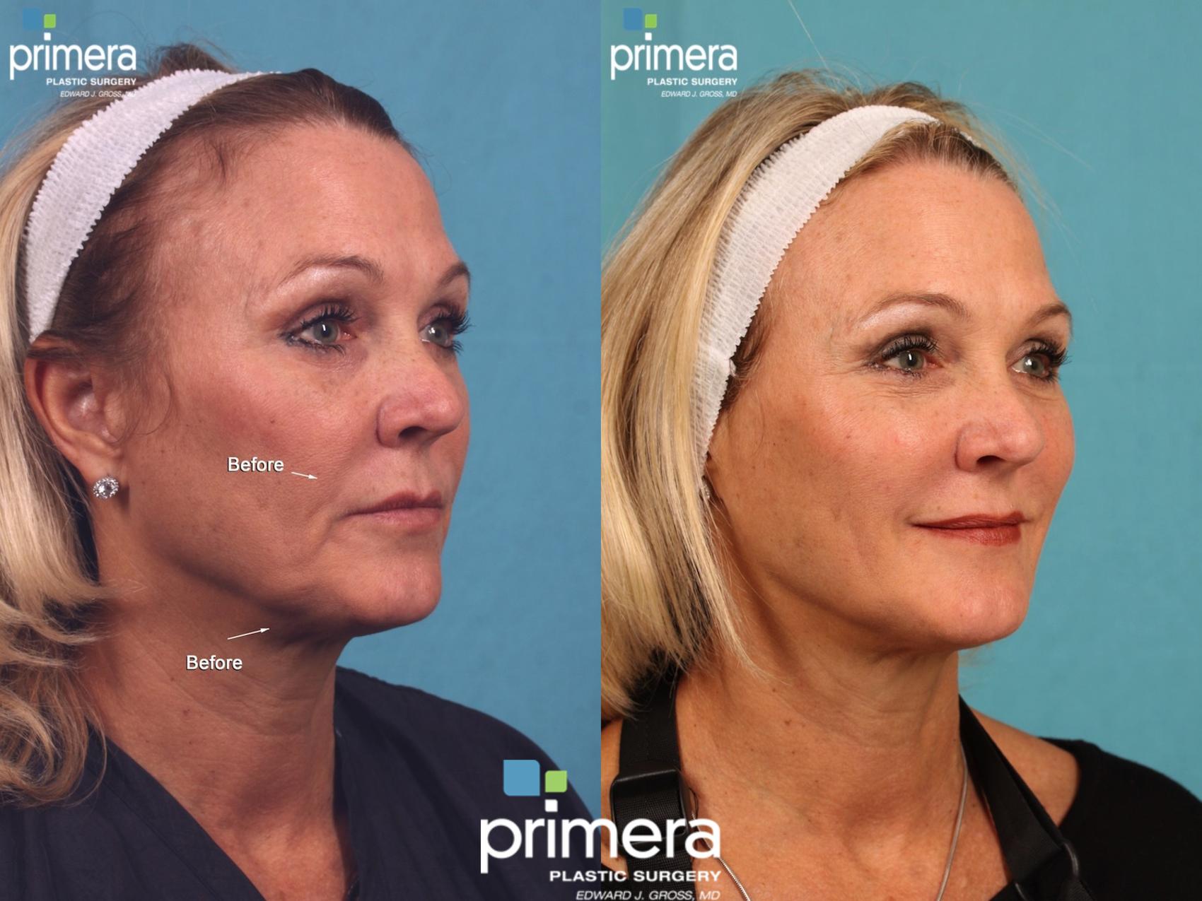 Plastic Surgery Jowls Before After Pictures Female Infoupdate