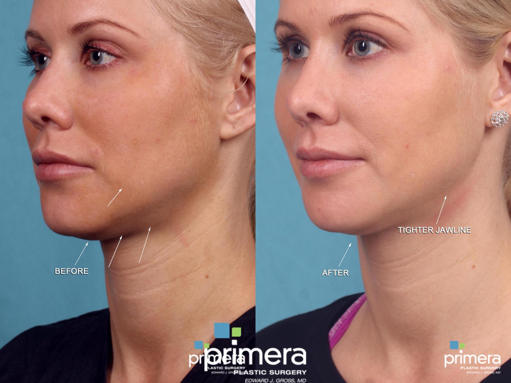 Ulthera Facial Skin Tightening West Island, Montreal - Plastic Surgery