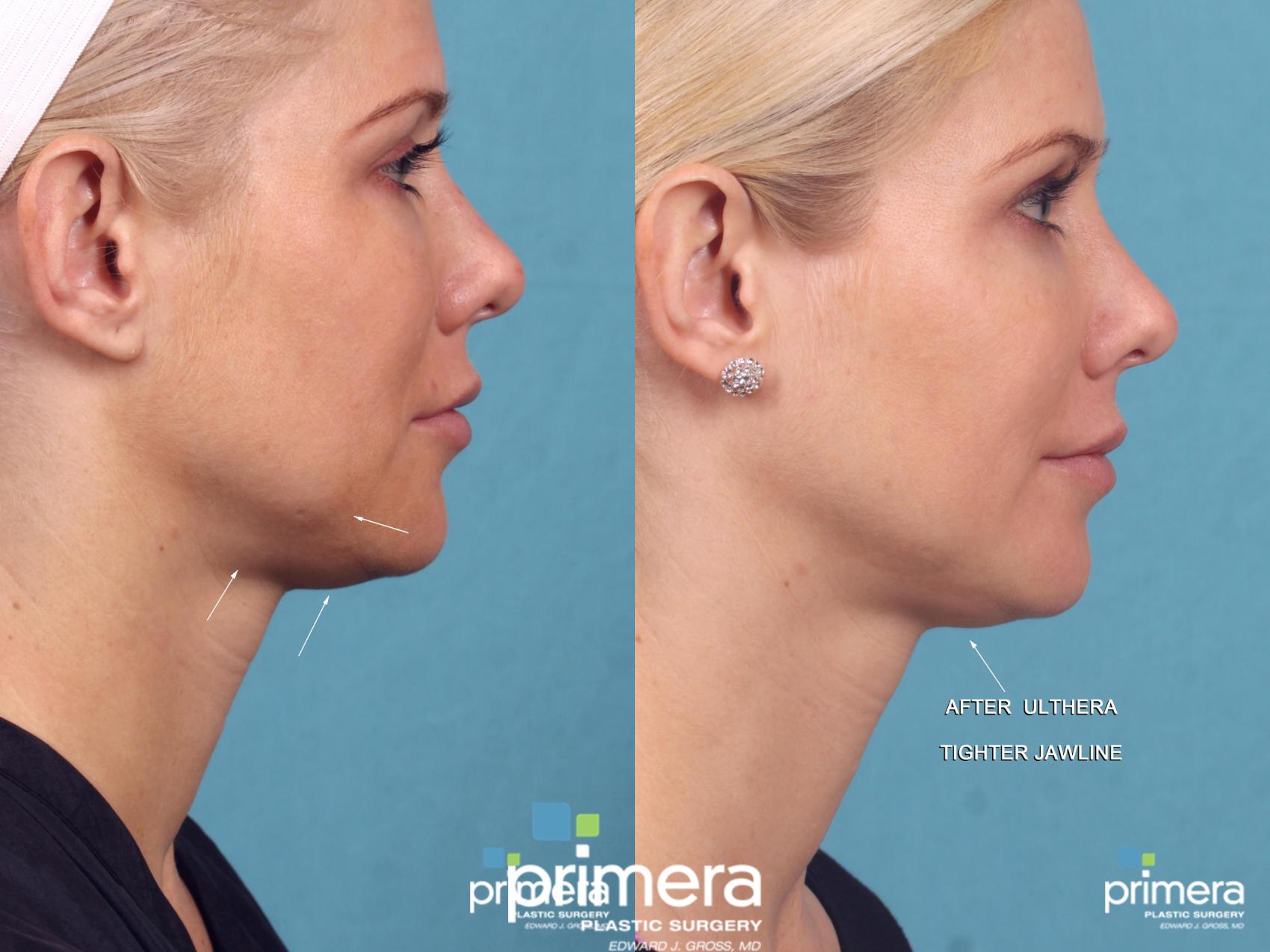 Ultherapy® Before and After Pictures Case 434 Orlando, Florida