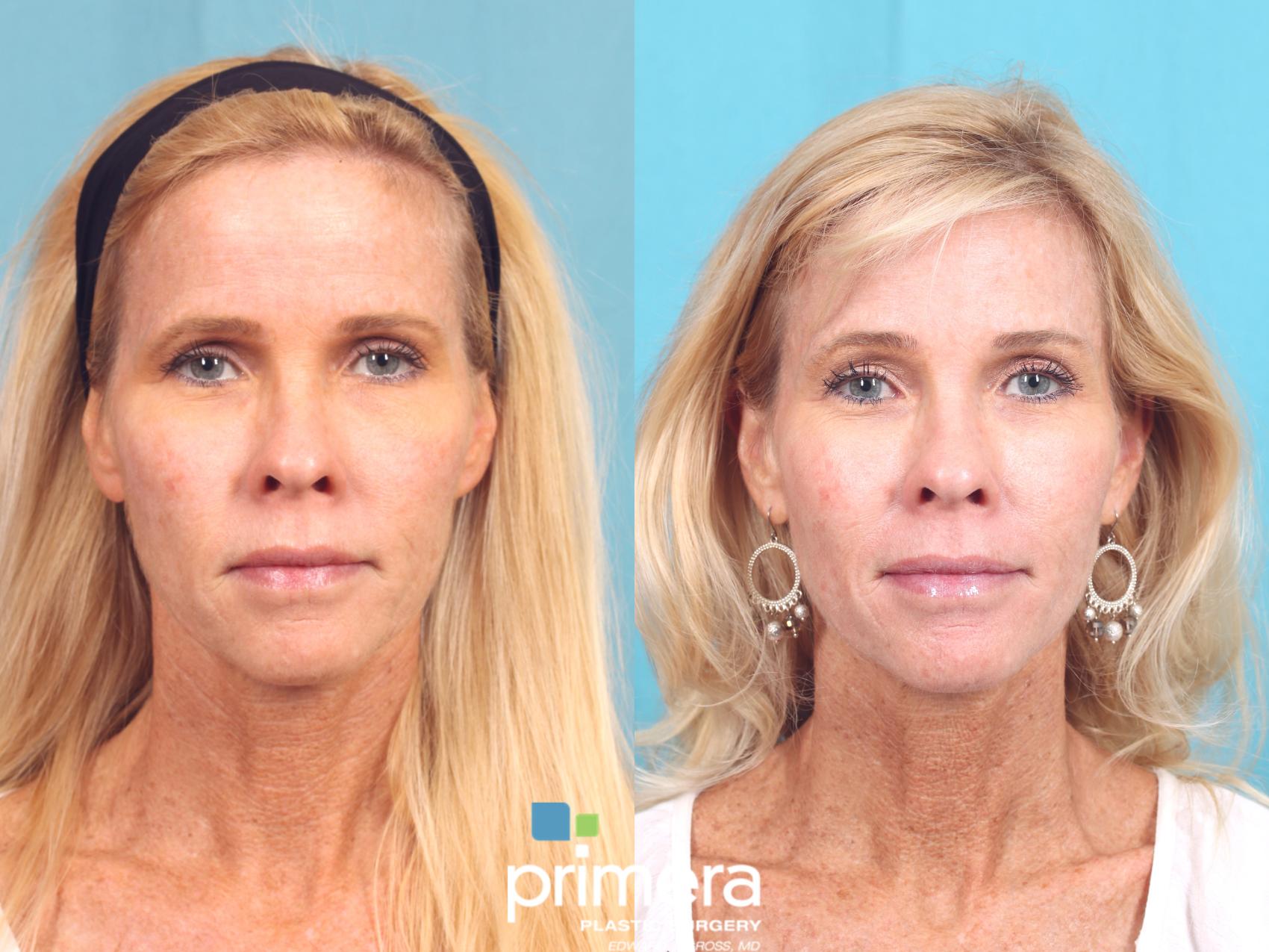 Ultherapy® Skin Tightening for Orlando & Winter Park, FL