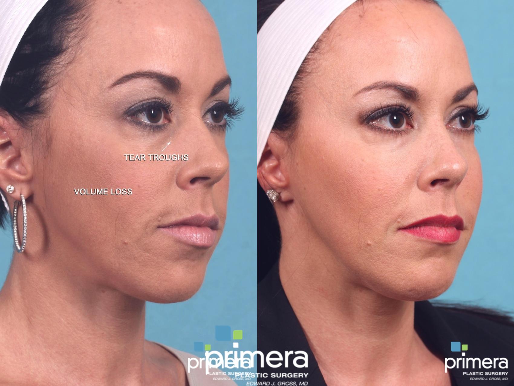 VOLUMA® Before and After Pictures Case 365 Orlando, Florida Primera