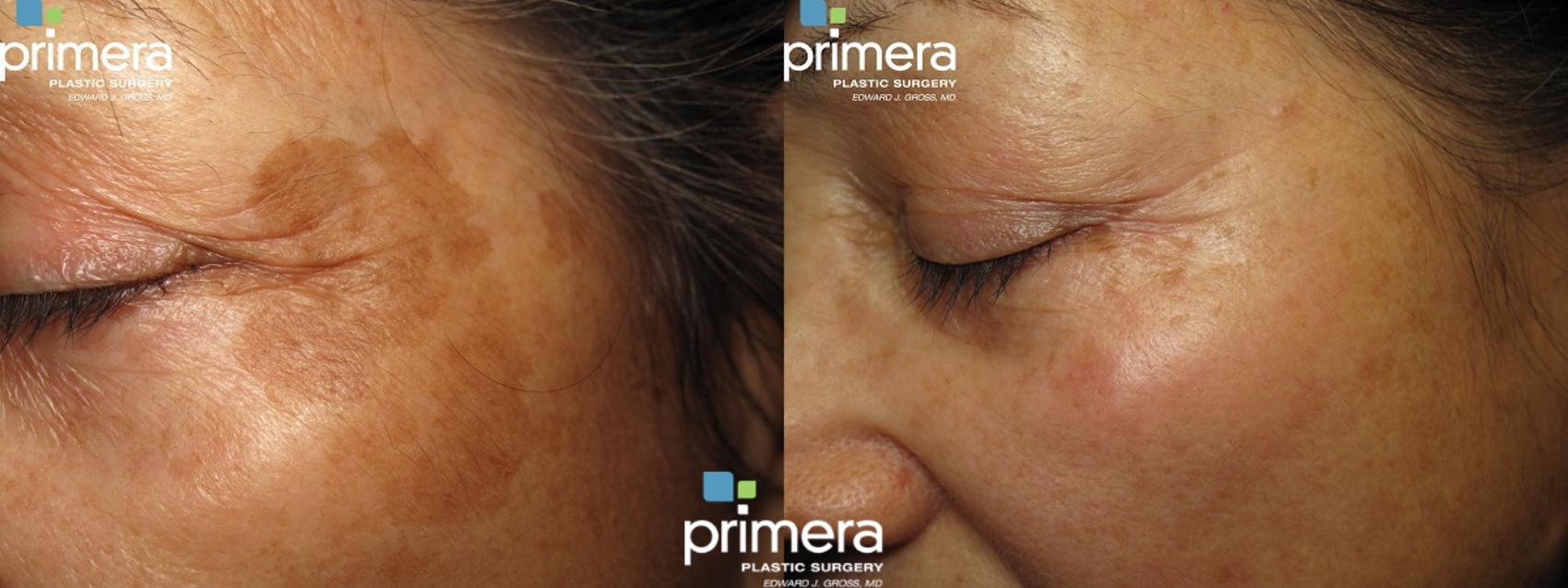 How Long Does Laser Skin Resurfacing Last Primera Plastic Surgery