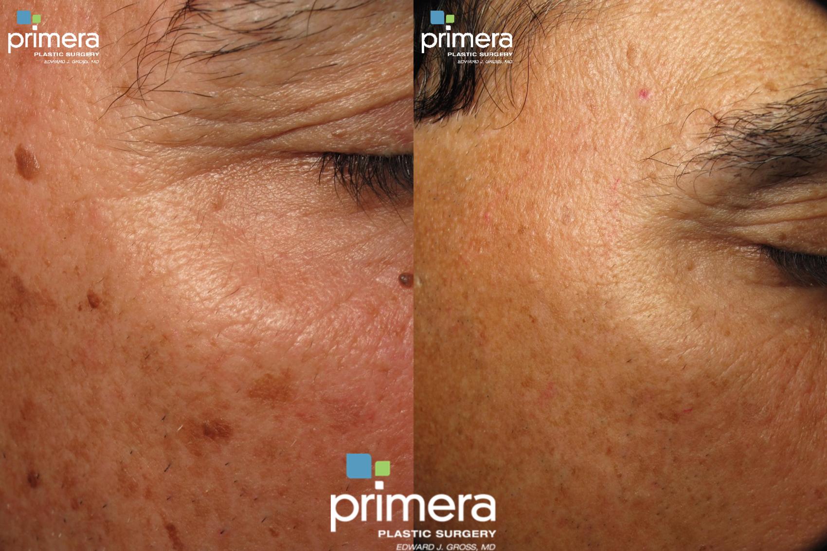 YAG Laser Skin Rejuvenation for Orlando, FL Primera